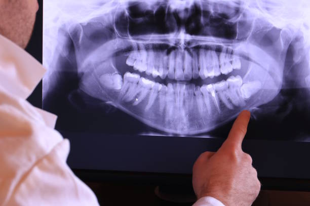 Best Emergency Wisdom Tooth Extraction in Commerce, TX